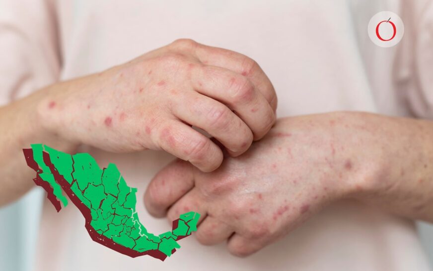 Gobierno dejó de gastar 70 % de recursos destinados a vacunas incluidas para Sarampión : PAN